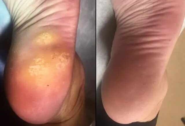 皮肤疣多由HPV所致，难治性疣该如何治疗？西多福韦疗效分析来了
