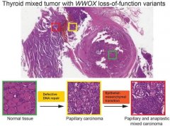 抑癌基因“倒戈”，甲状腺癌谜团终破解