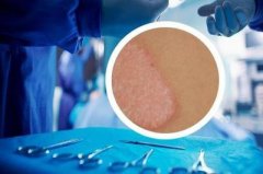 一年一针不是梦！超80%患者症状改善超90%，银屑病治疗迎来“便