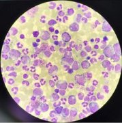 抗癌奇迹！慢性粒细胞白血病十年生存率从50%飙升至90%