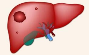 肝癌治疗迎来“三联时代”！三大研究证实TACE联合靶免疗效倍增